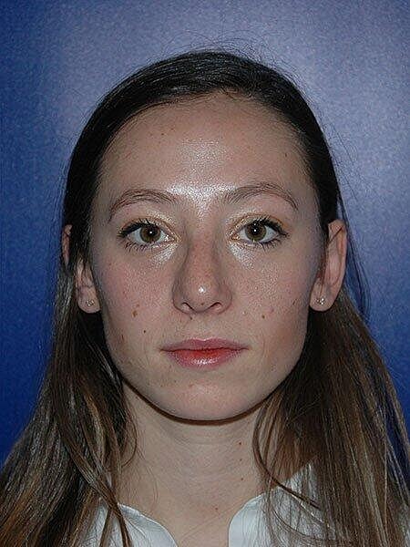 Rhinoplasty Before & After