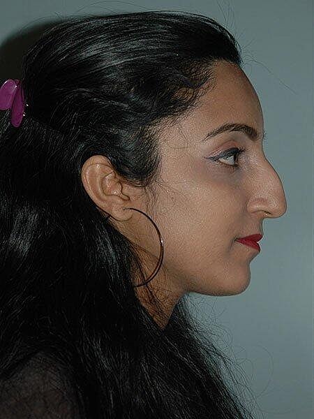 Rhinoplasty Before & After