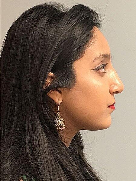 Rhinoplasty Before & After
