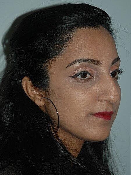 Rhinoplasty Before & After