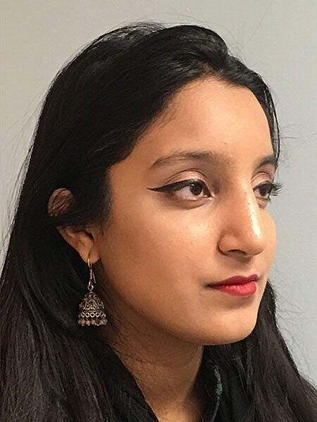 Rhinoplasty Before & After