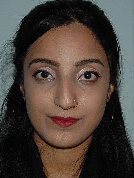 Rhinoplasty Before & After