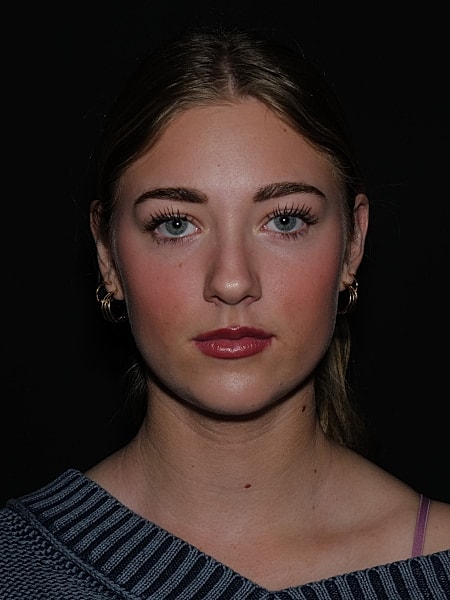 Rhinoplasty Before & After