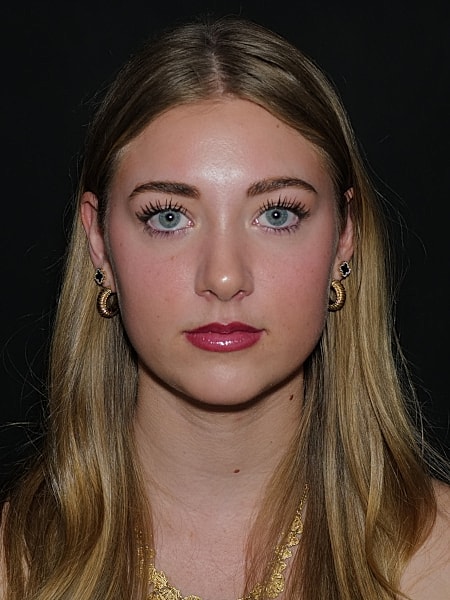 Rhinoplasty Before & After