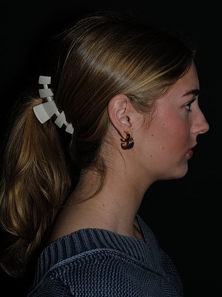Rhinoplasty Before & After