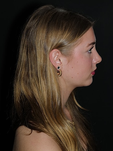 Rhinoplasty Before & After