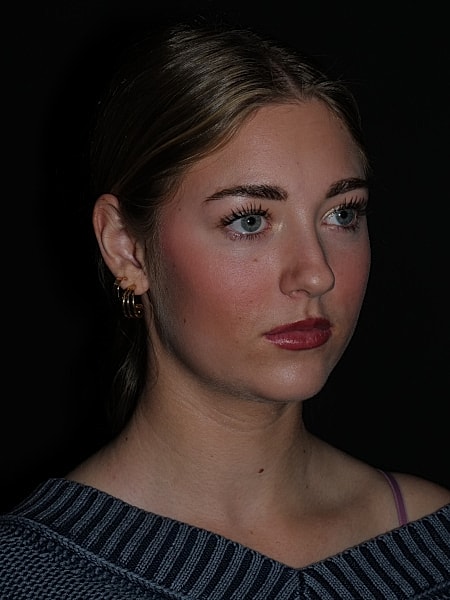 Rhinoplasty Before & After