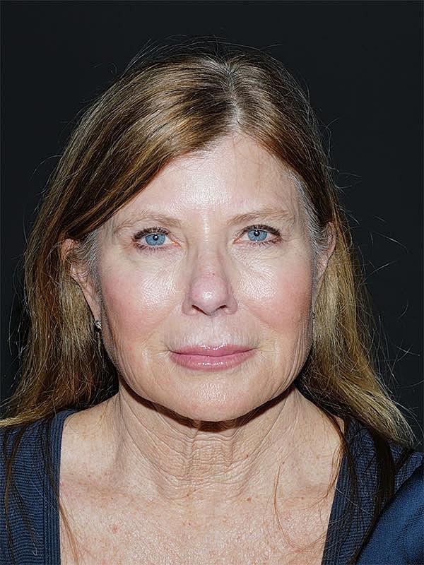 Brow lift Before & After