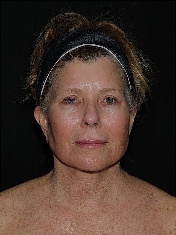 Brow lift Before & After