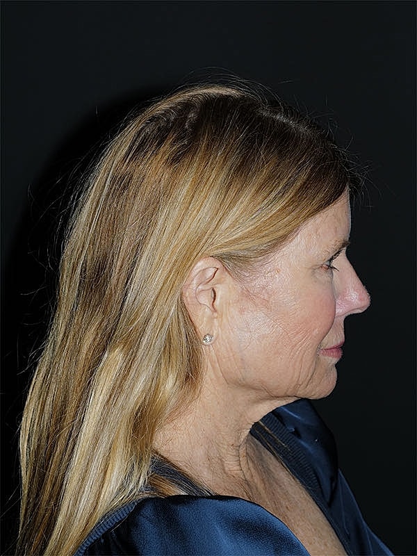 Brow Lift Before & After