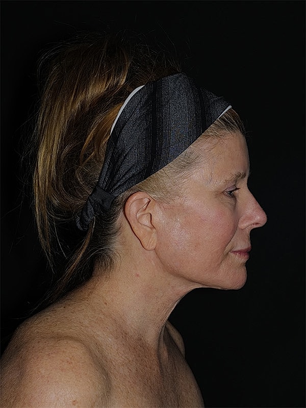 Brow Lift Before & After