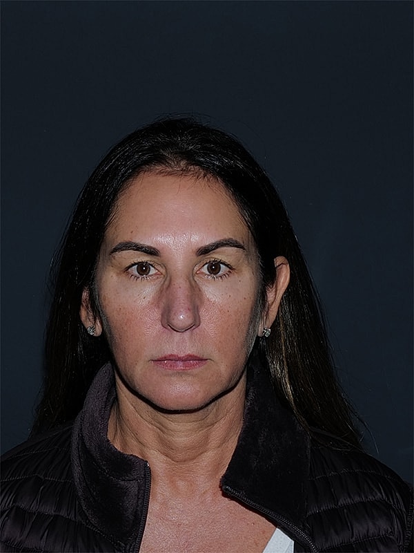 Brow Lift Before & After