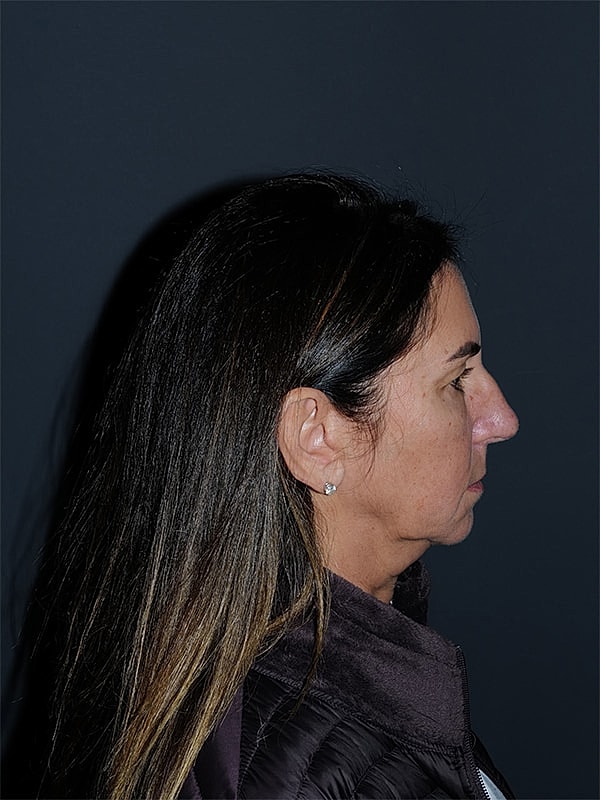 Brow Lift Before & After