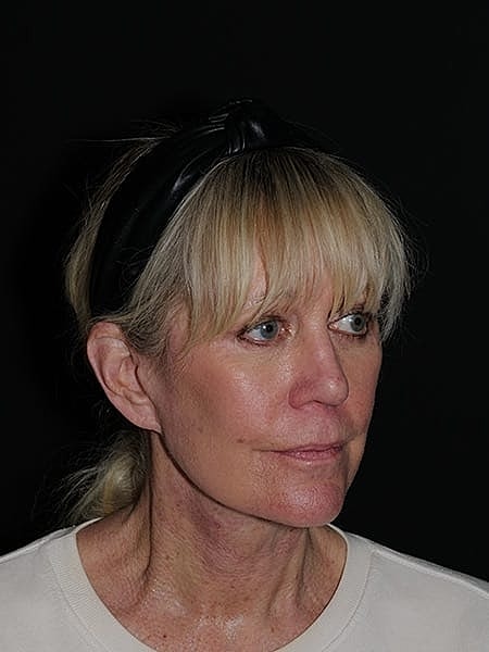 Brow Lift Before & After