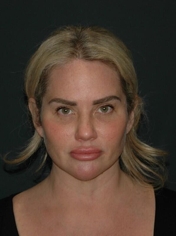 Brow Lift Before & After