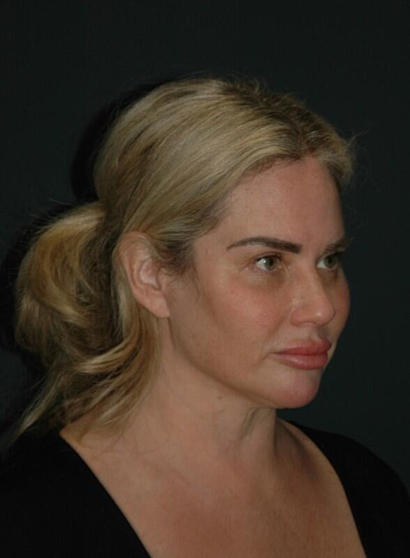 Brow Lift Before & After