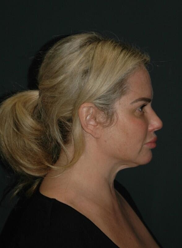 Brow Lift Before & After