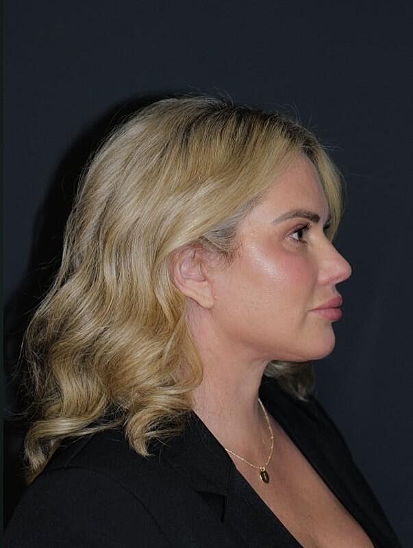 Brow Lift Before & After