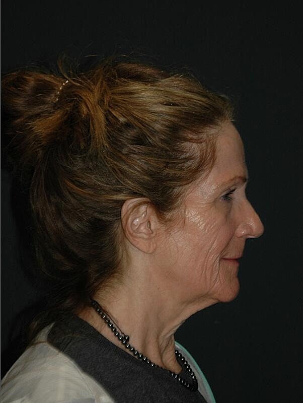 Brow Lift Before & After