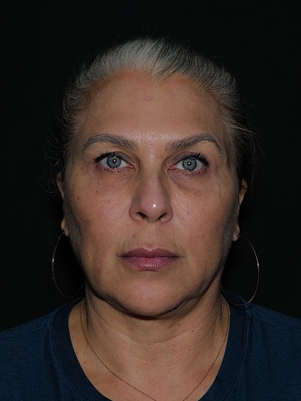Brow Lift Before & After