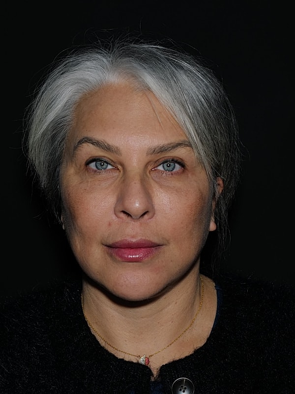 Brow Lift Before & After