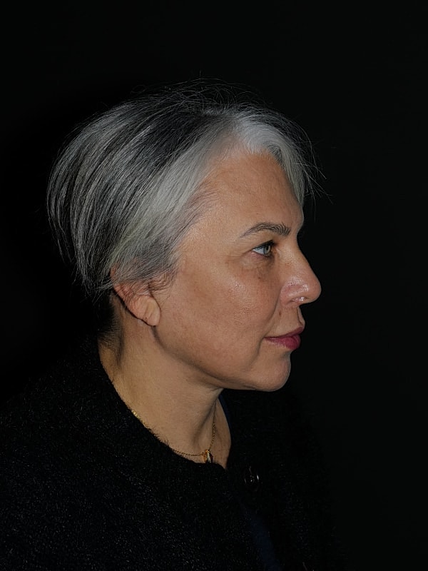 Brow Lift Before & After