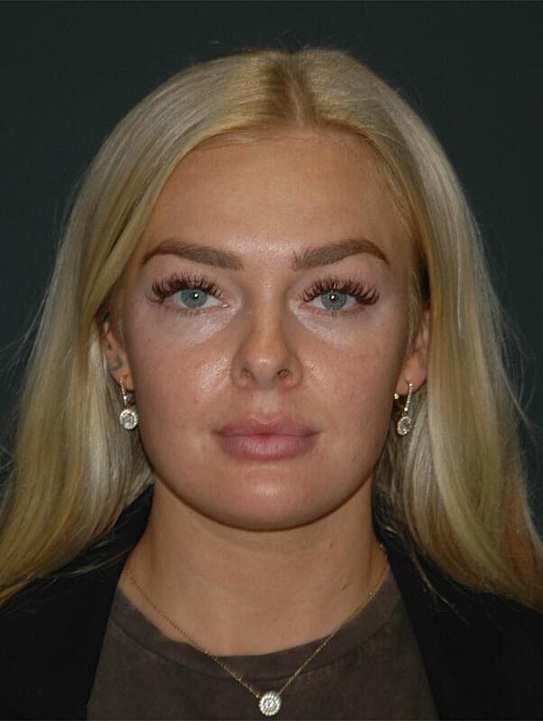 Lip Augmentation Before & After