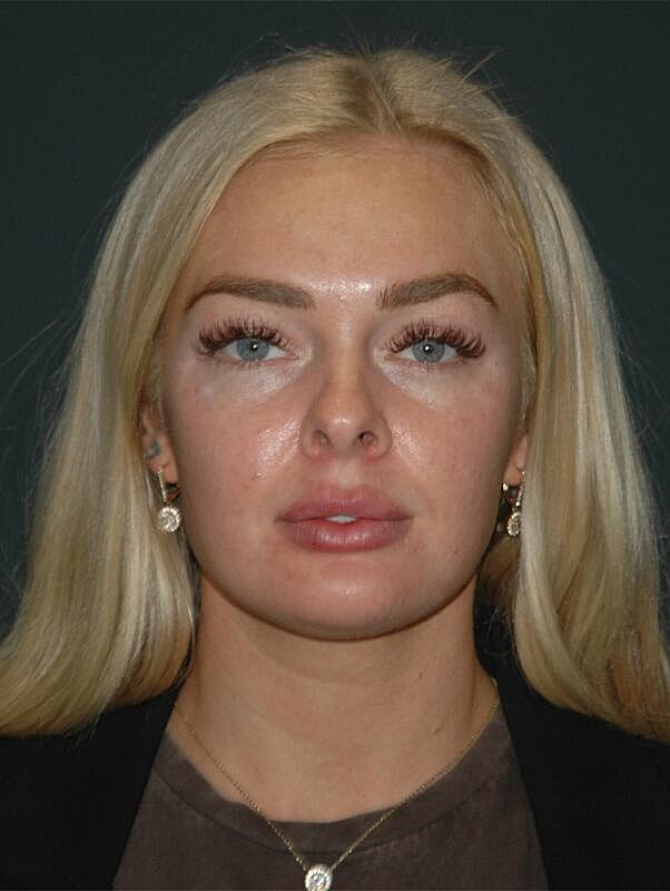 Lip Augmentation Before & After