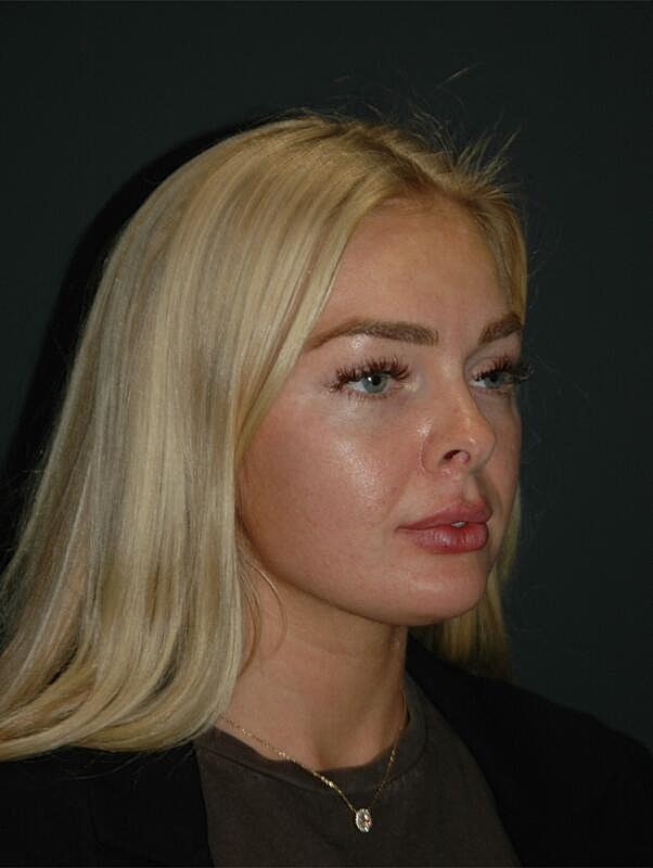 Lip Augmentation Before & After