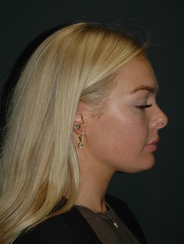 Lip Augmentation Before & After