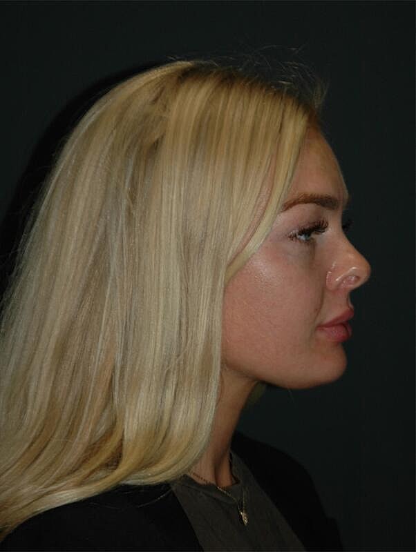 Lip Augmentation Before & After