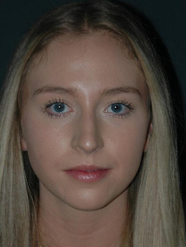 Lip Augmentation Before & After