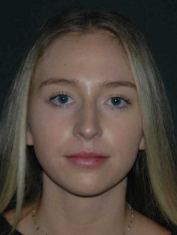Lip Augmentation Before & After