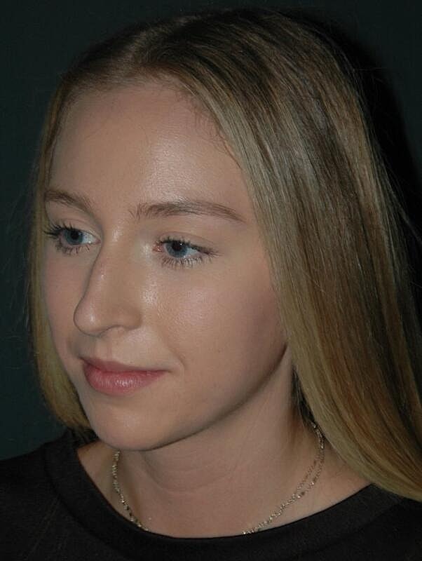 Lip Augmentation Before & After