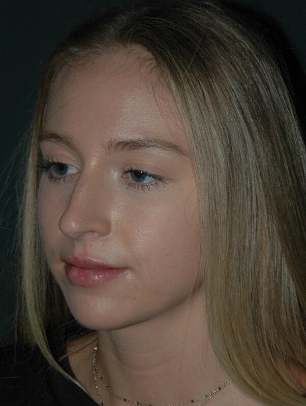 Lip Augmentation Before & After