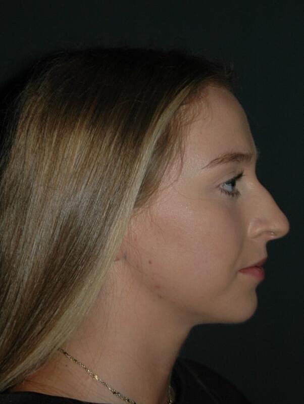 Lip Augmentation Before & After