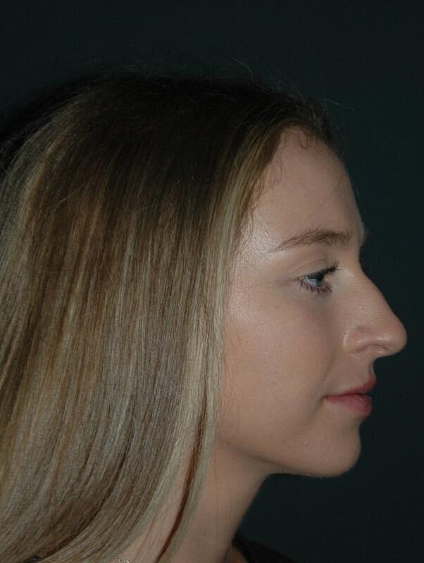 Lip Augmentation Before & After