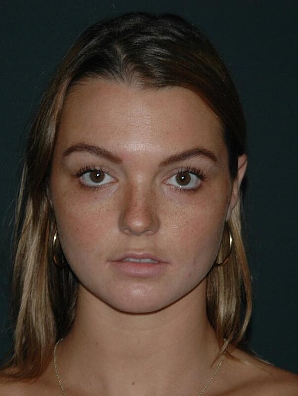 Lip Augmentation Before & After