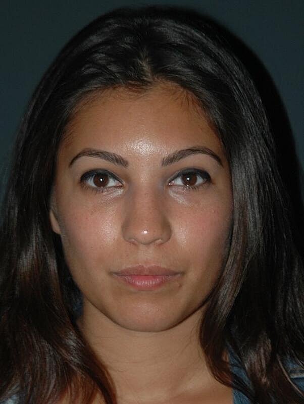 Lip Augmentation Before & After