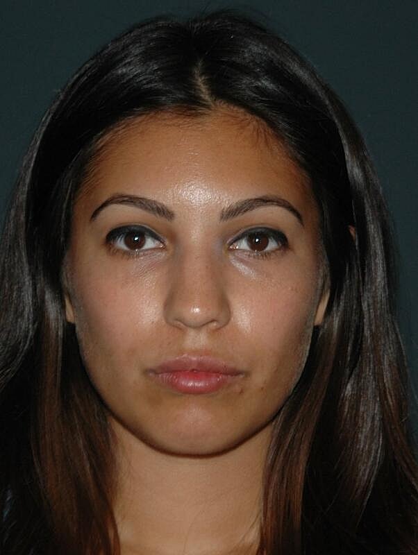 Lip Augmentation Before & After