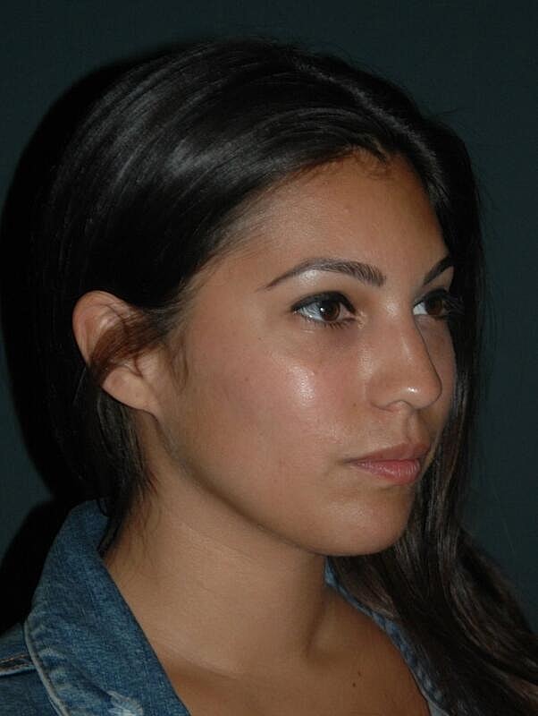 Lip Augmentation Before & After