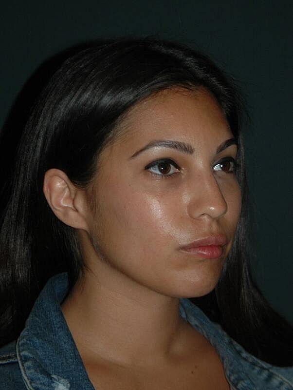 Lip Augmentation Before & After