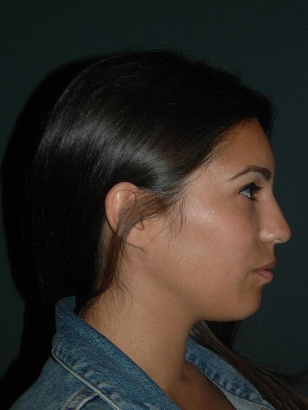 Lip Augmentation Before & After