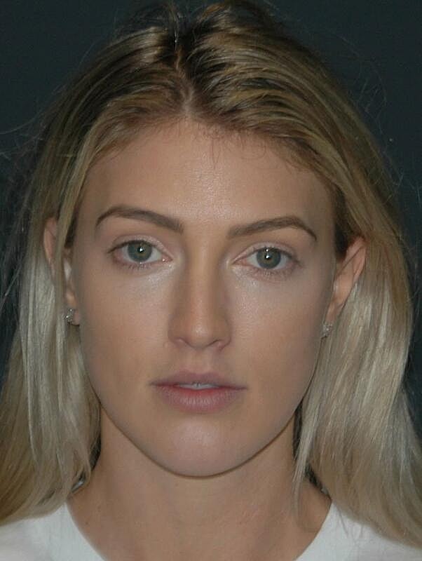 Lip Augmentation Before & After