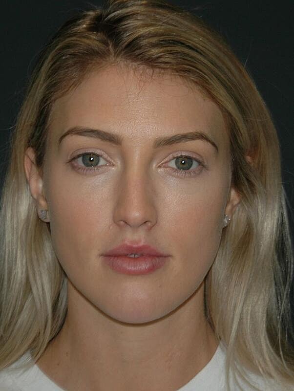 Lip Augmentation Before & After