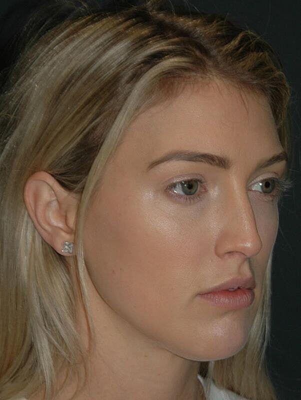 Lip Augmentation Before & After