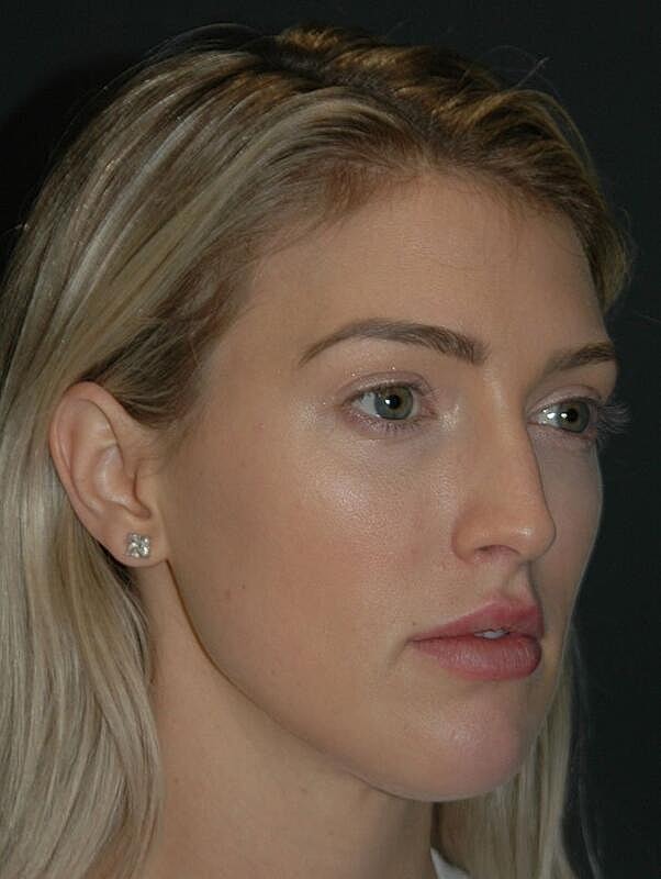 Lip Augmentation Before & After