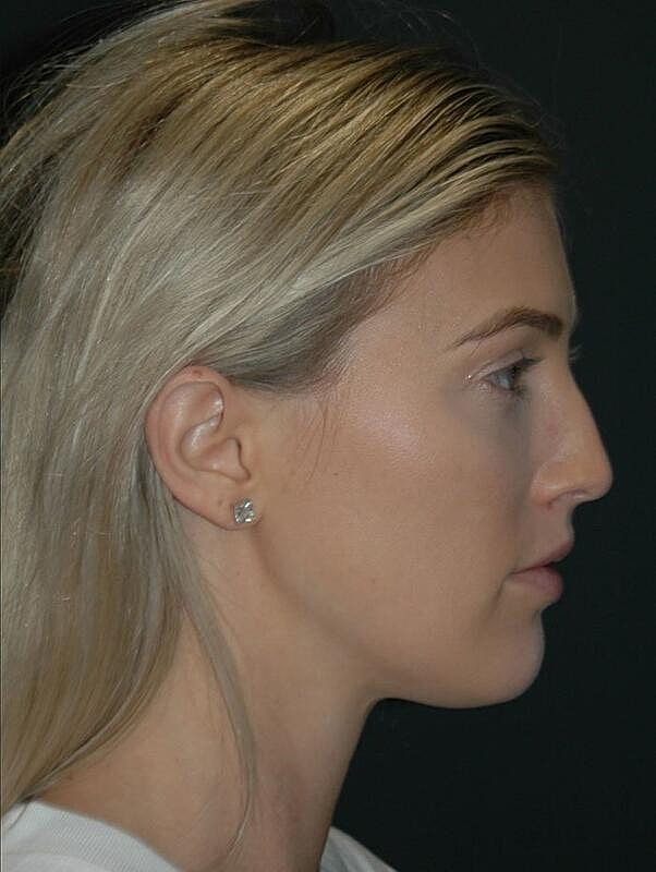 Lip Augmentation Before & After