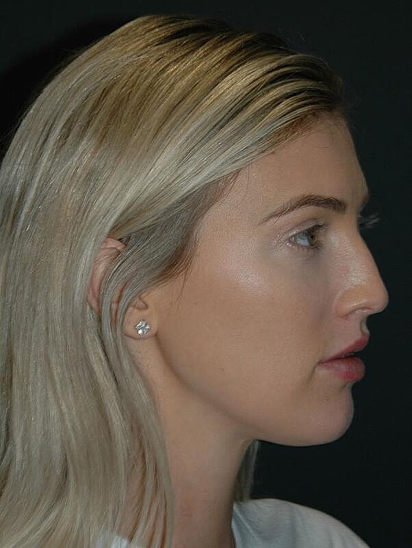 Lip Augmentation Before & After