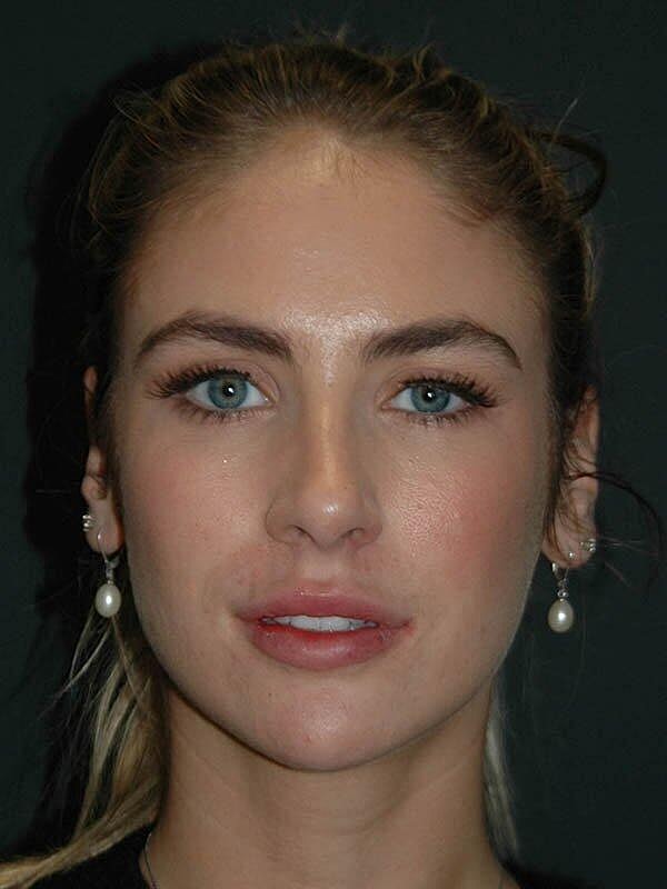 Lip Augmentation Before & After